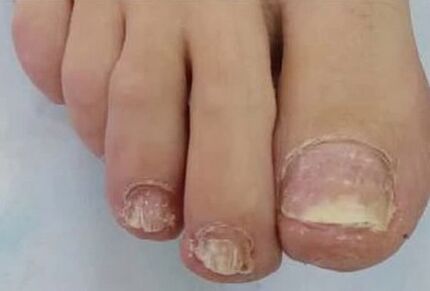 Nails were severely affected by the fungus