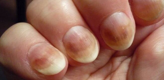 Infection with mycosis of nails