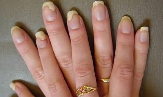 This is what the nail fungus looks like in the exacerbation stage