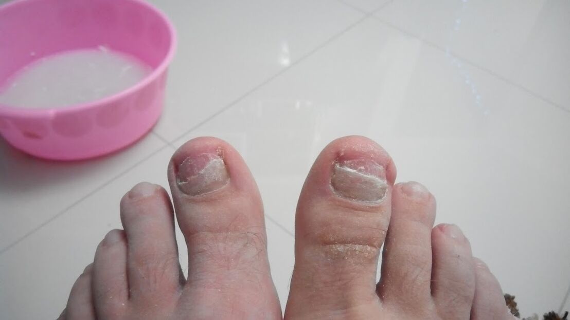The fungus on the legs