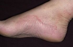 The fungal damage to the foot