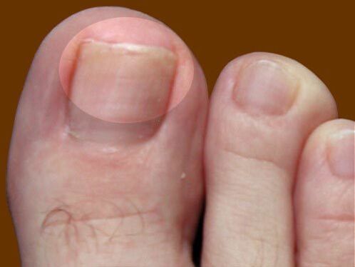 The lesion of the fungus