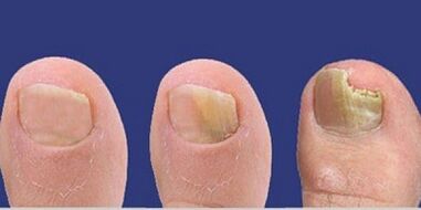 Stages of development of nail fungus